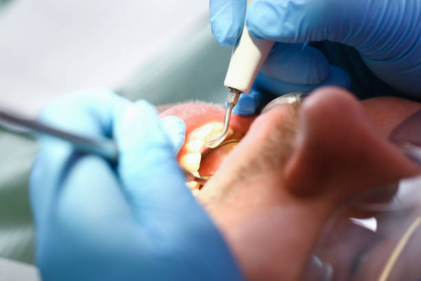 Best Emergency Dentist for Knocked-Out Tooth in Mill Creek, WA