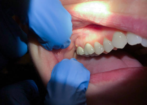 Best Emergency Dentist for Lost Fillings or Crowns in Mill Creek, WA